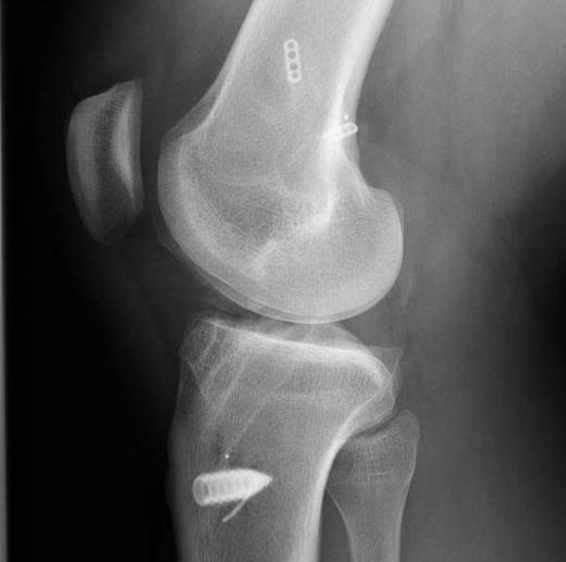 Revision ACL 4 Lateral Xray